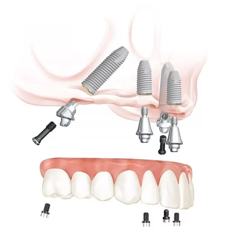 Имплантация sup aznona com. All on 4 имплантация Нобель. Имплант зуба Osstem. Nobel Biocare имплантаты.